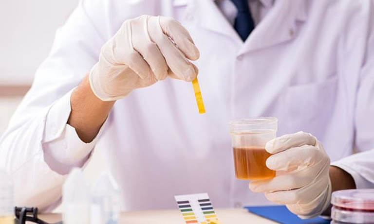 Xét nghiệm nước tiểu và ý nghĩa của các chỉ số