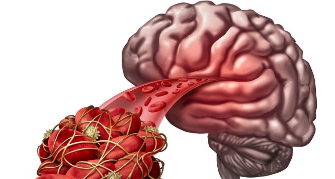 Anh sắp phê duyệt thuốc trị đột quỵ giá rẻ Anh sắp phê duyệt thuốc trị đột quỵ giá rẻ