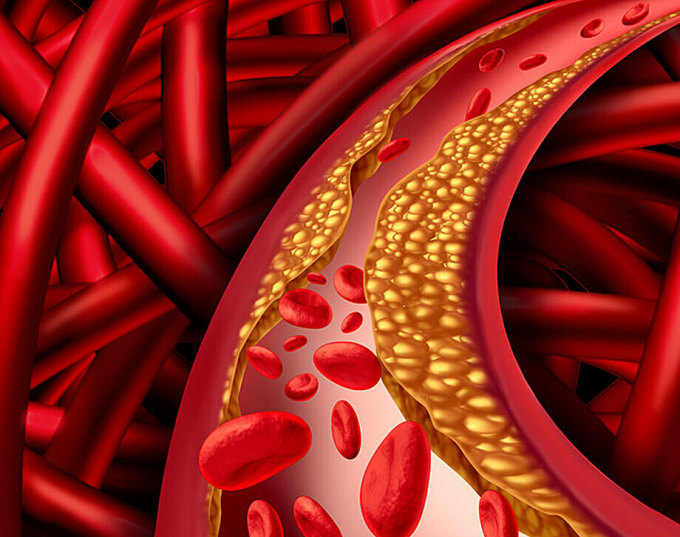 Dấu hiệu ở chân cảnh báo cholesterol cao Dấu hiệu ở chân cảnh báo cholesterol cao