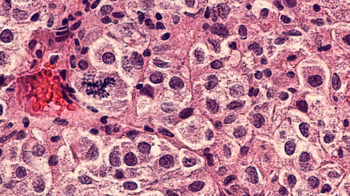 Hy vọng từ vaccine mRNA điều trị ung thư