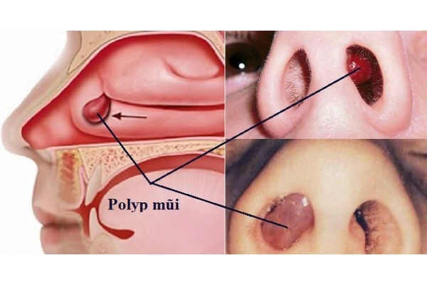 5 biến chứng do polyp mũi