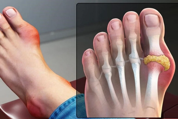 Chỉ số acid uric bao nhiêu cảnh báo bệnh gout?