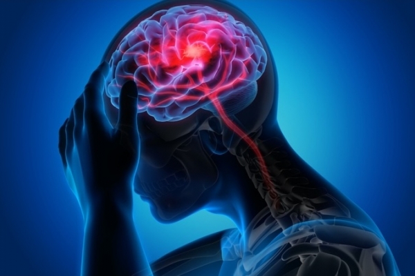 Dấu hiệu cảnh báo sớm đột quỵ