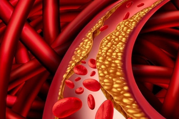 Dấu hiệu ở chân cảnh báo cholesterol cao