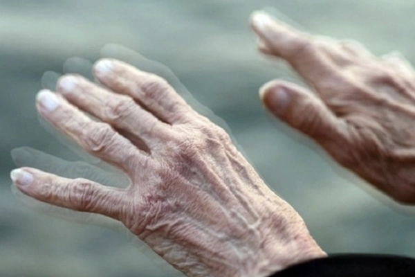 Khiếm khuyết vận động thường gặp ở người bệnh Parkinson